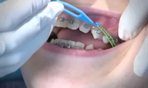 Chân răng bật ra khỏi ổ sau hai năm niềng